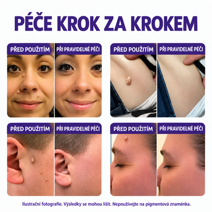 COLTURE® náplast s mikrojehlami k odstranění bradavic a znamének