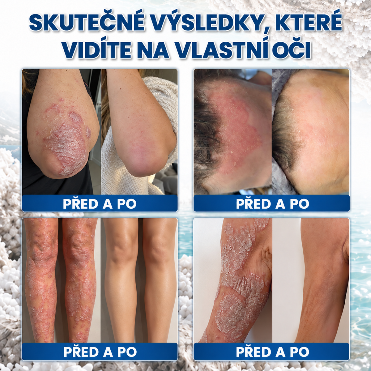 🎁💧 Roltine® Speciální krém pro péči o pokožku s lupénkou – ✅ Dermatologicky testováno
