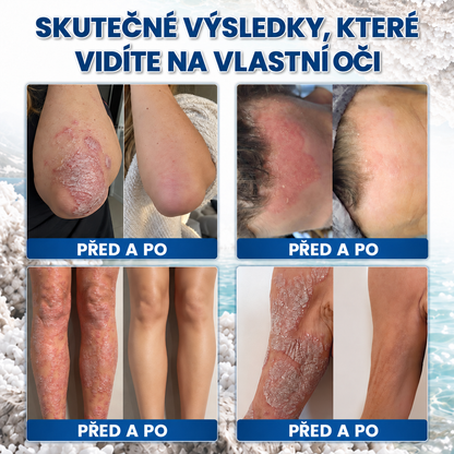 🎁💧 Roltine® Speciální krém pro péči o pokožku s lupénkou – ✅ Dermatologicky testováno