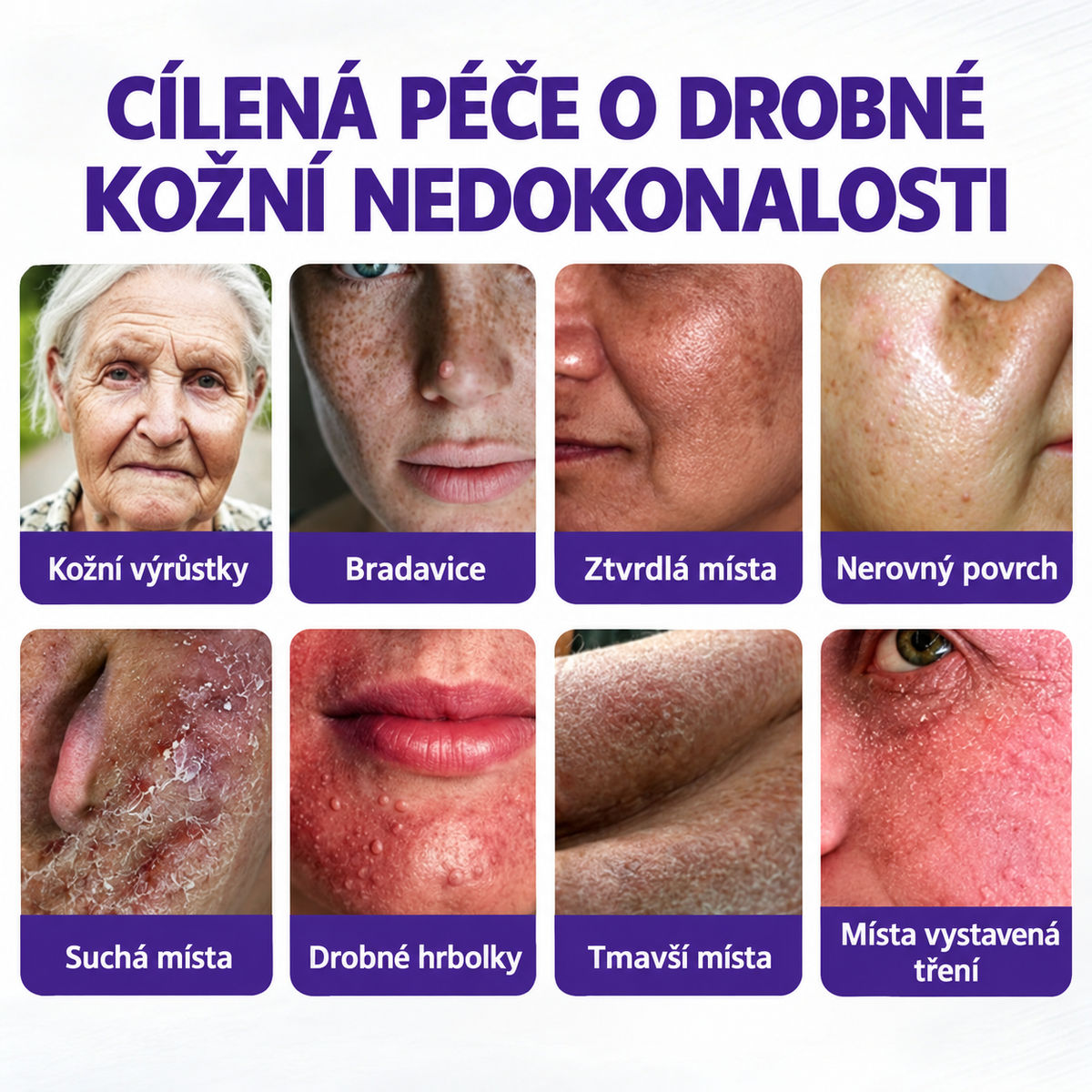 COLTURE® náplast s mikrojehlami k odstranění bradavic a znamének