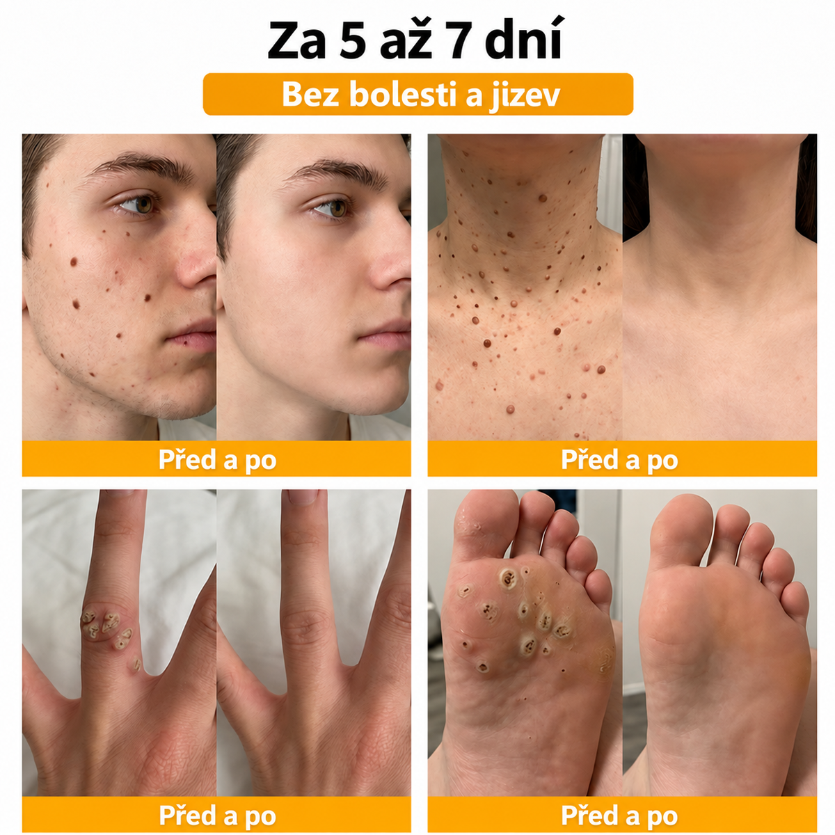 🐝 Roltine®: Pokročilá péče se včelím jedem proti bradavicím a kožním nedokonalostem 👨‍⚕️ Inspirováno dermatologickou vědou | Cílená péče v pohodlí domova