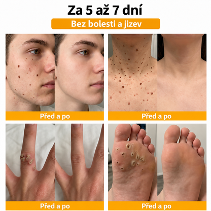 🐝 Roltine®: Pokročilá péče se včelím jedem proti bradavicím a kožním nedokonalostem 👨‍⚕️ Inspirováno dermatologickou vědou | Cílená péče v pohodlí domova