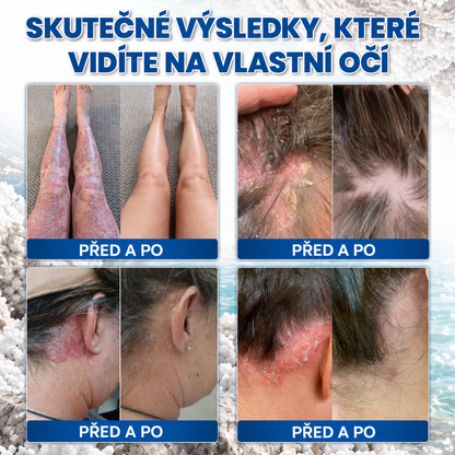 🎁💧 Roltine® Speciální krém pro péči o pokožku s lupénkou – ✅ Dermatologicky testováno
