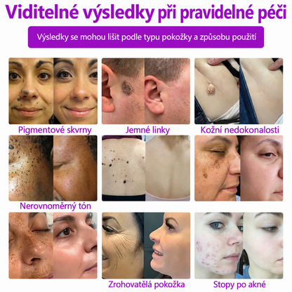 𝐉𝐚𝐬𝐬𝐞𝐞𝐦® Pokročilé neinvazivní CO₂ laserové pero pro zdokonalení pokožky 🎉 (Šetrně odstraňuje bradavice, znaménka, stařecké skvrny a kožní výrůstky – bez bolesti a zbytečných starostí!)