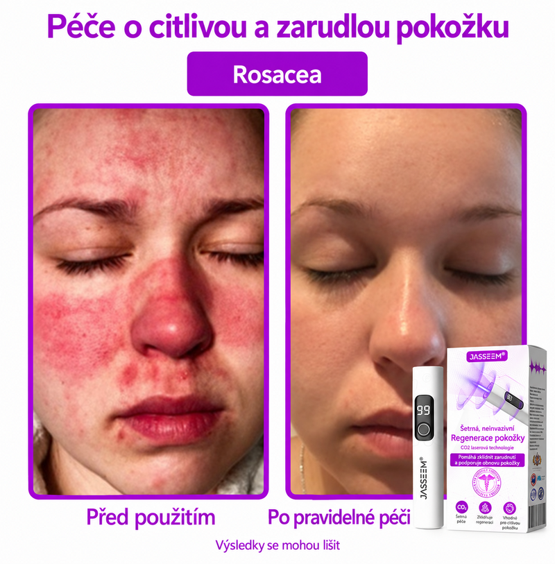 𝐉𝐚𝐬𝐬𝐞𝐞𝐦® Pokročilé neinvazivní CO₂ laserové pero pro zdokonalení pokožky 🎉 (Šetrně odstraňuje bradavice, znaménka, stařecké skvrny a kožní výrůstky – bez bolesti a zbytečných starostí!)