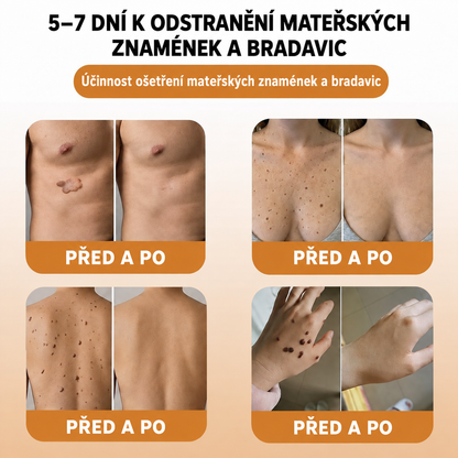 🐝 Roltine®: Pokročilá péče se včelím jedem proti bradavicím a kožním nedokonalostem 👨‍⚕️ Inspirováno dermatologickou vědou | Cílená péče v pohodlí domova