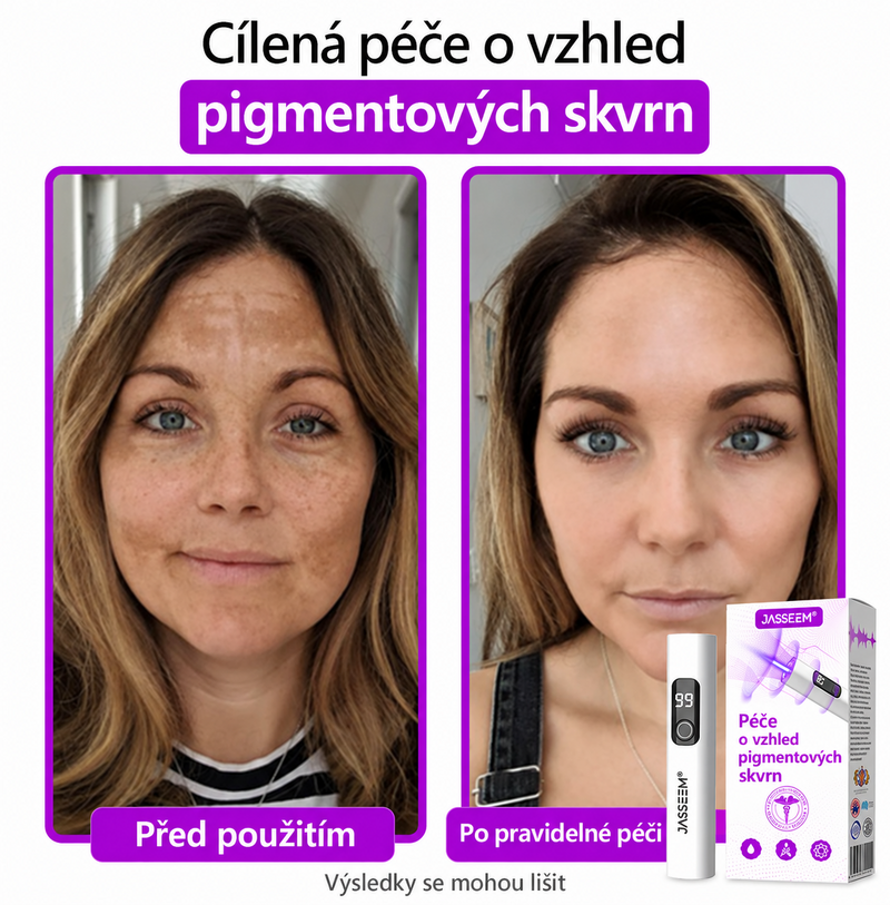 𝐉𝐚𝐬𝐬𝐞𝐞𝐦® Pokročilé neinvazivní CO₂ laserové pero pro zdokonalení pokožky 🎉 (Šetrně odstraňuje bradavice, znaménka, stařecké skvrny a kožní výrůstky – bez bolesti a zbytečných starostí!)