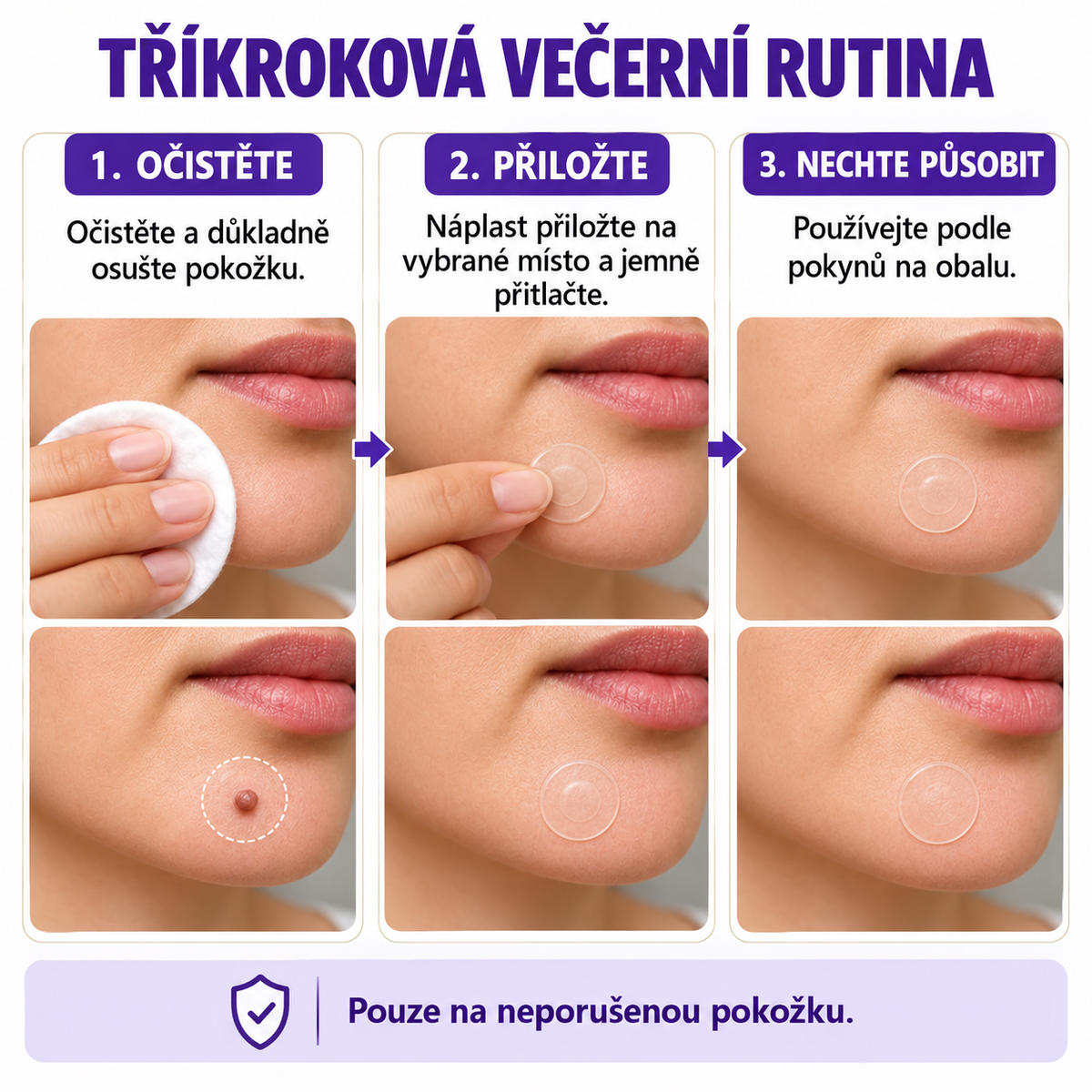 COLTURE® náplast s mikrojehlami k odstranění bradavic a znamének