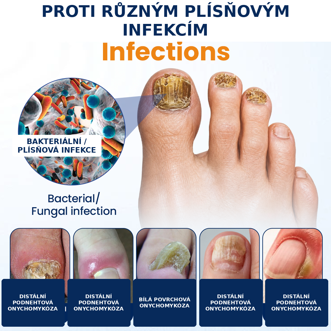 Roltine® Sprej proti plísním nehtů