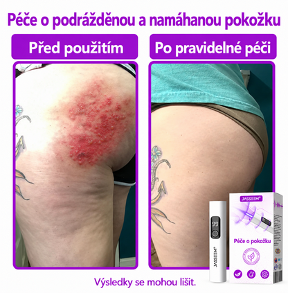 𝐉𝐚𝐬𝐬𝐞𝐞𝐦® Pokročilé neinvazivní CO₂ laserové pero pro zdokonalení pokožky 🎉 (Šetrně odstraňuje bradavice, znaménka, stařecké skvrny a kožní výrůstky – bez bolesti a zbytečných starostí!)