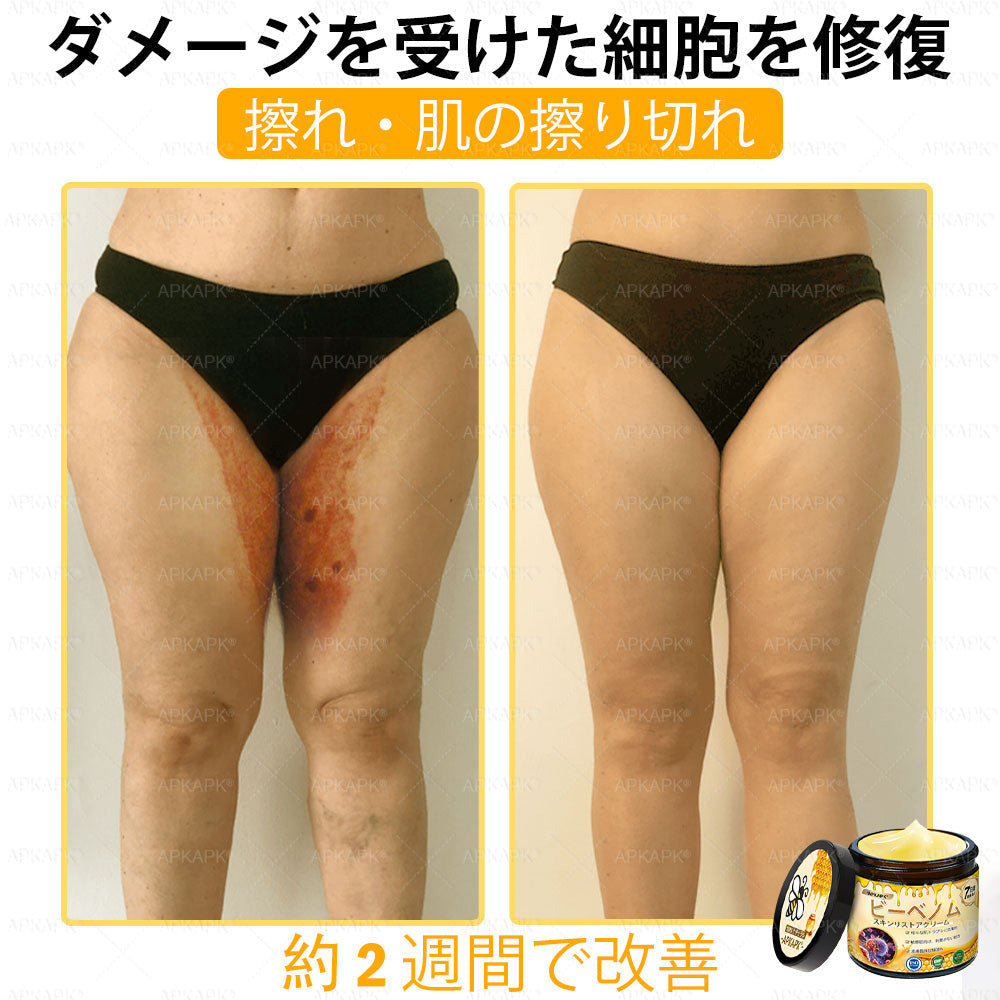 ✨APKAPK® 𝗠É𝗛𝗠É𝗥𝗘𝗚 総合クリーム🥇 皮膚の隆起に対するケアには以下が含まれます： 加齢によるシミ、傷跡、いぼ、皮膚の隆起、脂肪の塊、ニキビ、湿疹、乾癬、反転性ニキビ、しわ、皮膚の老化およびその他の問題🔥