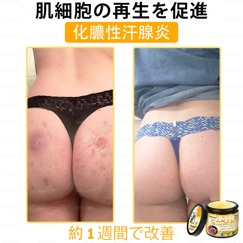 ✨APKAPK® 𝗠É𝗛𝗠É𝗥𝗘𝗚 総合クリーム🥇 皮膚の隆起に対するケアには以下が含まれます： 加齢によるシミ、傷跡、いぼ、皮膚の隆起、脂肪の塊、ニキビ、湿疹、乾癬、反転性ニキビ、しわ、皮膚の老化およびその他の問題🔥