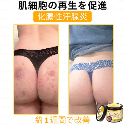 ✨APKAPK® 𝗠É𝗛𝗠É𝗥𝗘𝗚 総合クリーム🥇 皮膚の隆起に対するケアには以下が含まれます： 加齢によるシミ、傷跡、いぼ、皮膚の隆起、脂肪の塊、ニキビ、湿疹、乾癬、反転性ニキビ、しわ、皮膚の老化およびその他の問題🔥