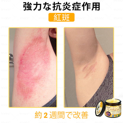 ✨APKAPK® 𝗠É𝗛𝗠É𝗥𝗘𝗚 総合クリーム🥇 皮膚の隆起に対するケアには以下が含まれます： 加齢によるシミ、傷跡、いぼ、皮膚の隆起、脂肪の塊、ニキビ、湿疹、乾癬、反転性ニキビ、しわ、皮膚の老化およびその他の問題🔥