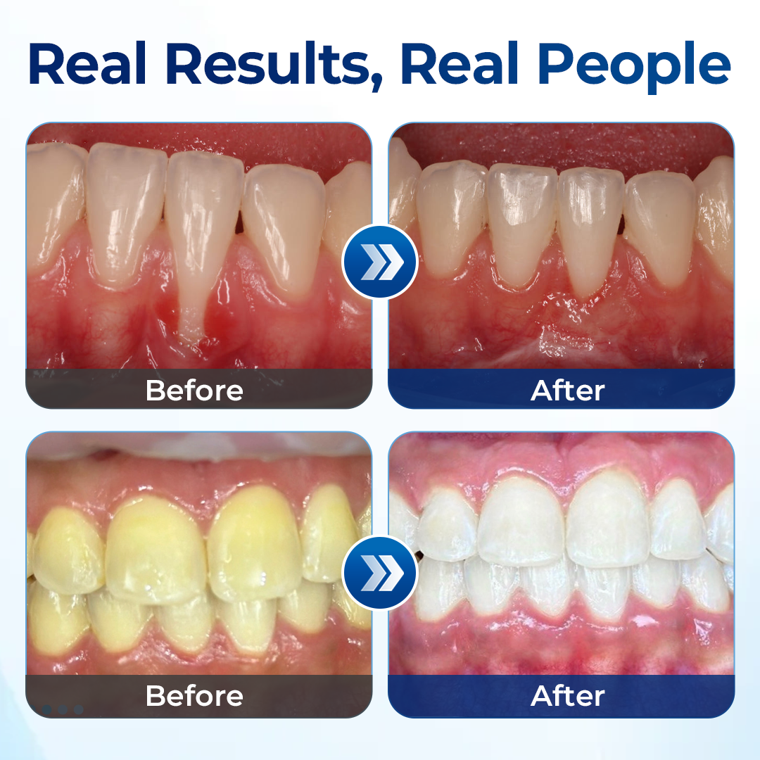 Mresio® RegenDent Advanced Tooth & Gum Renewal Device