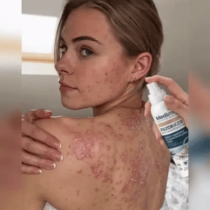 🎁💧 Roltine® Speciální krém pro péči o pokožku s lupénkou – ✅ Dermatologicky testováno