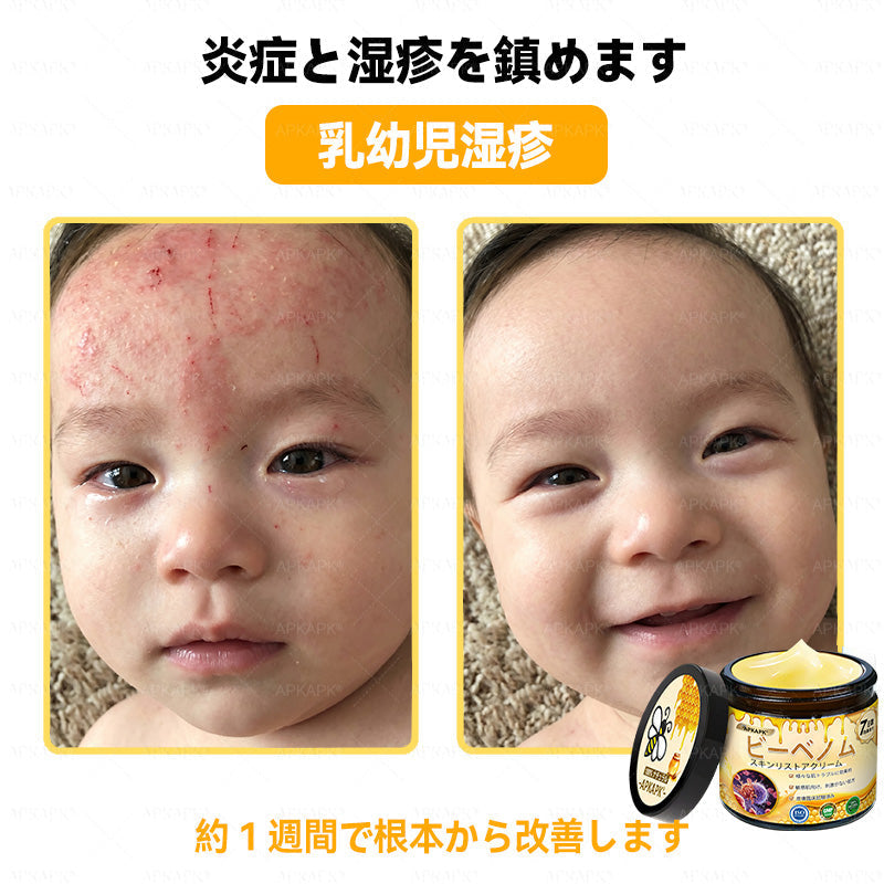 ✨APKAPK® 𝗠É𝗛𝗠É𝗥𝗘𝗚 総合クリーム🥇 皮膚の隆起に対するケアには以下が含まれます： 加齢によるシミ、傷跡、いぼ、皮膚の隆起、脂肪の塊、ニキビ、湿疹、乾癬、反転性ニキビ、しわ、皮膚の老化およびその他の問題🔥