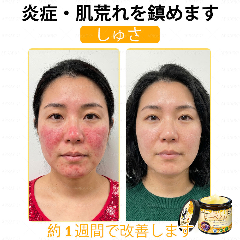 ✨APKAPK® 𝗠É𝗛𝗠É𝗥𝗘𝗚 総合クリーム🥇 皮膚の隆起に対するケアには以下が含まれます： 加齢によるシミ、傷跡、いぼ、皮膚の隆起、脂肪の塊、ニキビ、湿疹、乾癬、反転性ニキビ、しわ、皮膚の老化およびその他の問題🔥