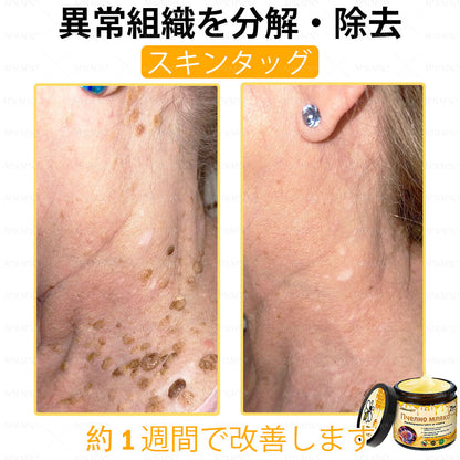 ✨APKAPK® 𝗠É𝗛𝗠É𝗥𝗘𝗚 総合クリーム🥇 皮膚の隆起に対するケアには以下が含まれます： 加齢によるシミ、傷跡、いぼ、皮膚の隆起、脂肪の塊、ニキビ、湿疹、乾癬、反転性ニキビ、しわ、皮膚の老化およびその他の問題🔥
