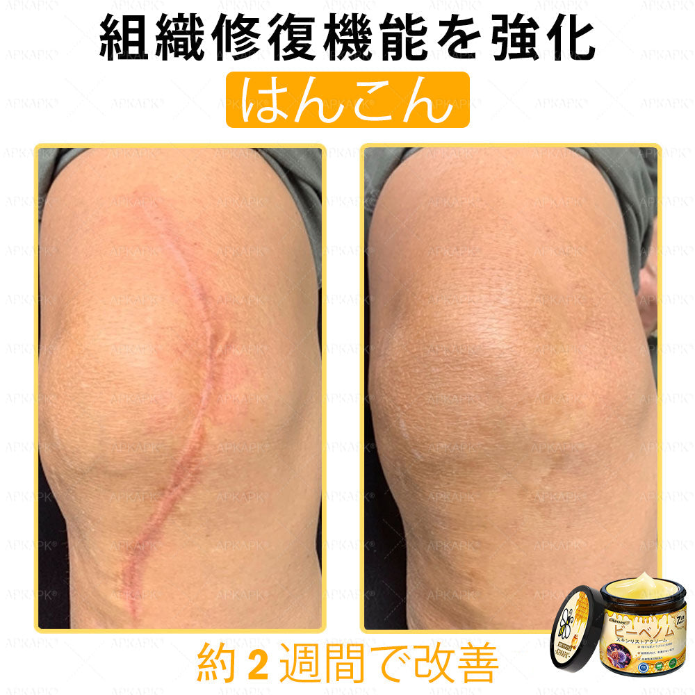 ✨APKAPK® 𝗠É𝗛𝗠É𝗥𝗘𝗚 総合クリーム🥇 皮膚の隆起に対するケアには以下が含まれます： 加齢によるシミ、傷跡、いぼ、皮膚の隆起、脂肪の塊、ニキビ、湿疹、乾癬、反転性ニキビ、しわ、皮膚の老化およびその他の問題🔥