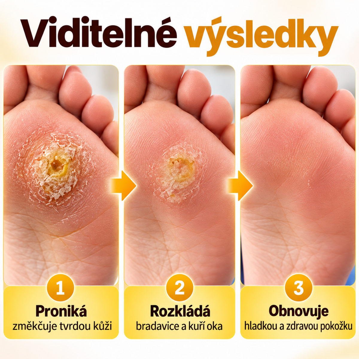 Roltine® BeeClear – regenerační krém na bradavice a kuří oka